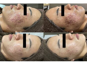 いおり骨盤整体 リブート(RE:BOOT)/ハーブピーリング