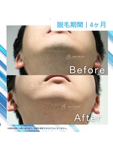 メンズクリア 八王子店/【メンズクリア】お客様の施術例