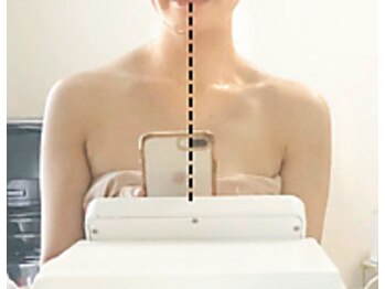 ラグラン銀座メディカルエステ 高輪ゲートウェイ店/セルマジ/一撃級ビフォアフ