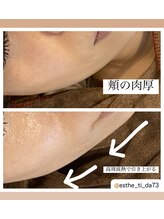 ティーダ(Ti-Da)/小顔/ツヤ/口横ぽにょ/二重顎/首