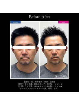 メンズエフディ ファウンデーション(メンズFD)/スカルプケア＋EMSポレーション