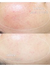 ソワ 吉塚店(soi)/赤みがなくなりツヤUP♪