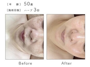 ルナスーリヤ 表参道店/ハーブピーリング