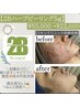 【2Bバイオハーブピーリング5g+角質除去】肌質改善ニキビケア/肌荒れに剥離◎
