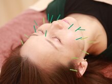 いちまる鍼灸院/美容鍼でたるみケアスッキリ小顔