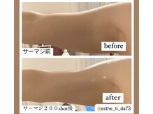 ティーダ(Ti-Da)/柔らか脂肪/固脂肪/振り袖二の腕