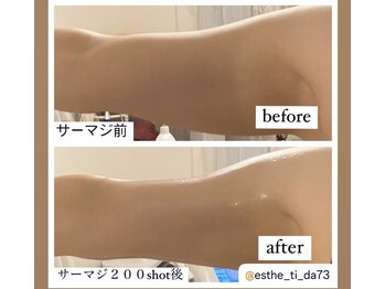 ティーダ(Ti-Da)/柔らか脂肪/固脂肪/振り袖二の腕