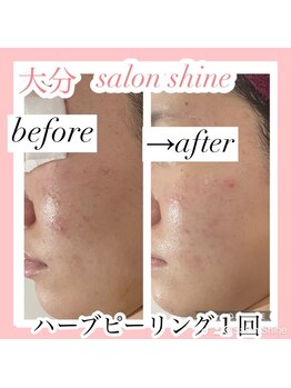 サロンシャイン(Salon Shine)/ハードハーブピーリング１回