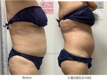 スラリ(SLARI)/【腹部　脂肪冷却】期間3か月