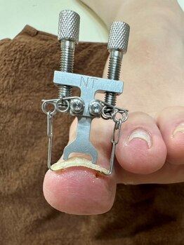 ネイルサロンアンドスクール ペルシャ(Persia)の写真/巻き爪でお悩みの方必見☆ネイルトリムでの巻き爪ケア!健康美な爪を目指します♪手の深爪ケアメニュー有り