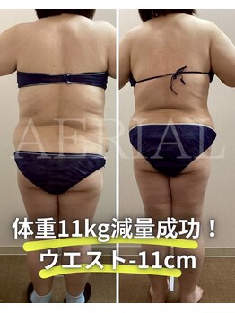 エアリアル 武雄店/脂肪冷却!お客様Before→After