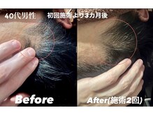 ヘッドサイエンス(HEADSCIENCE)の雰囲気（育毛促進鍼は数回でもこの効果!【男女共】にご実感頂いてます◎）