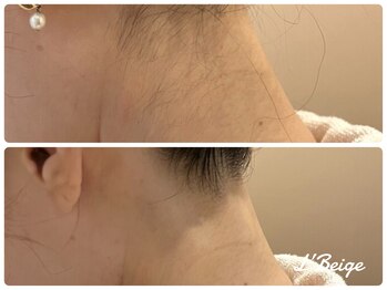 レ ベージュ(L’Beige)/1カ所から脱毛OK/シェービング込