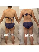 ナリスビューティー アンド ヘルス/キャビテーション