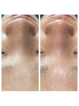 ベリル 金町店(Beryl)/毛穴洗浄でスッキリ！