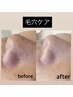 《毛穴》黒ずみ、開き解消ケア ４回コース 20,000円