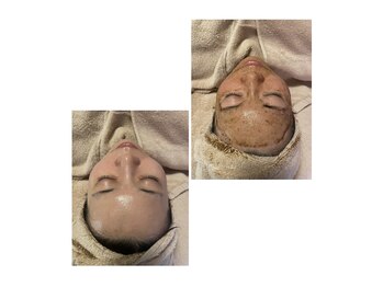 ネムズヴェリタ(nemu's Verita)の写真/毛穴の黒ずみ・ざらつき・詰まり・開きたるみ毛穴・過剰な皮脂・繰り返すニキビには育肌ハーブピーリング