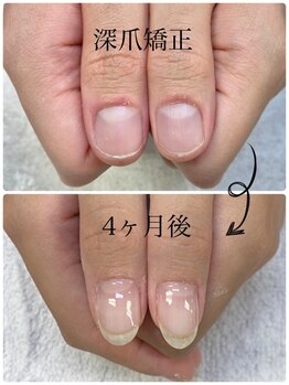 深爪矯正
