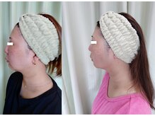 ソフィーム/小顔　脂肪減解導入フェイシャル