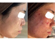 アネル 宮古島店(anel)/脱毛しながら徹底肌ケア