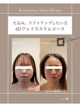 キサラ(Kisara)/目元の衰えしわたるみが気になる