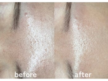 ホワイトアクア 鹿児島店(WHITE AQUA)/ララピール/肌質改善/毛穴