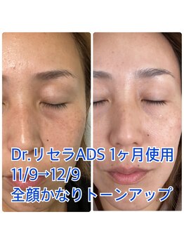 ナチュローズ新小岩/シミケアのお悩みご相談ください