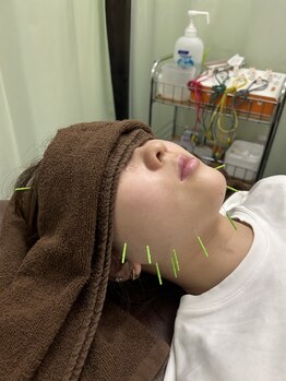 やぎ鍼灸接骨院/美容鍼でフェイスアップ