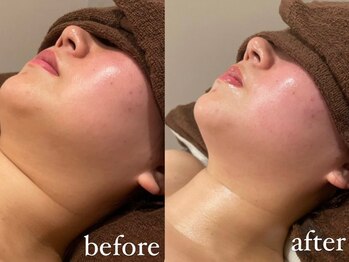 ウィズルーチェ 神栖店(with luce)/小顔１回効果★むくみ二重顎撲滅