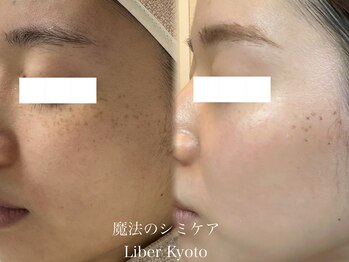 エステティック リベル キョウト 京都駅前店(Esthetic Liber Kyoto)/魔法のシミケア