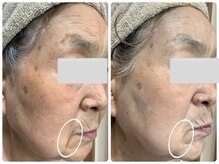 リュミエール デスポワール(Lumiere d'espoir)/ハーブピーリング