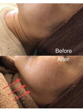 コウベ美容鍼灸治療院(KOBE美容鍼灸治療院)/たるみ改善１フェイスライン施術