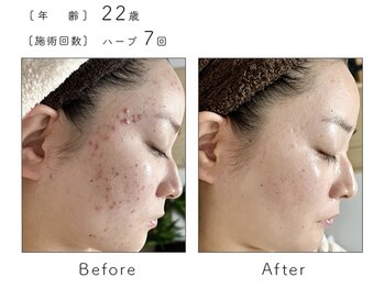 ルナスーリヤ 表参道店/ハーブピーリング