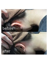 ミスターアンドミス脱毛専門店 難波店(Mr.&Ms.脱毛専門店)/えり足脱毛