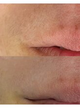 ユウユウ(YUYU)/毛穴洗浄＋部分WAX