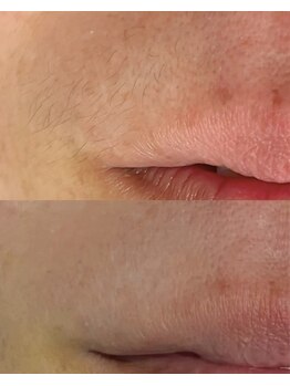 ユウユウ(YUYU)/毛穴洗浄+部分WAX