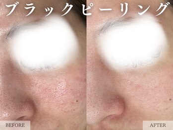 レヴェリー 心斎橋店(REVERIE)/- ブラックピーリング -