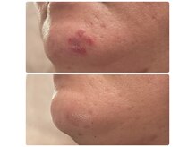 初回の写真を見ると…今は楽しんで肌と向き合えます！ハーブケア