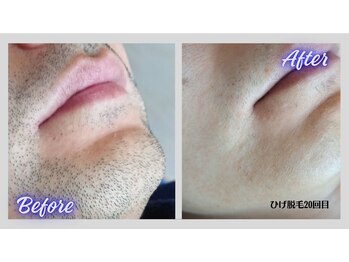 リボーン(Re bone)/今はメンズも脇脱毛！