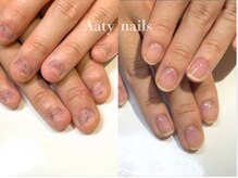アーティネイルズ(Aaty Nails)/【深爪矯正】ハンド
