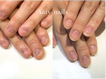 【深爪矯正】ハンド