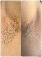 リジュベネ(rejuvena)/脇脱毛前後