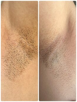 リジュベネ(rejuvena)/脇脱毛前後