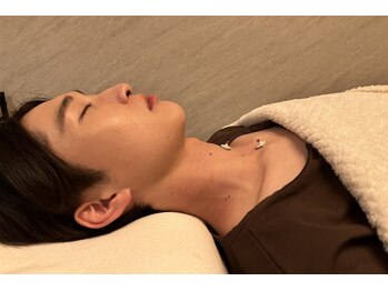 デルタエヌピー63+(δnp63+)/美容鍼施術風景[薬院/美容鍼]