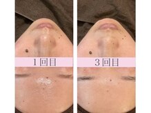 ココ 千里丘(Cocoh)/《ハイドラフェイシャル》全顔