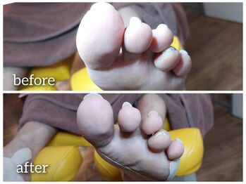 爪切り屋 足楽/【巻き爪・足底腱膜炎】