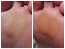 アンティ(Aunty)/肥厚したタコ（胼胝）除去