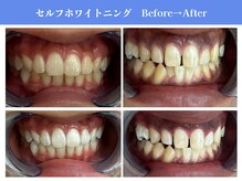 エクシアホワイトニング 岡崎店/セルフホワイトニングNo.1の実績