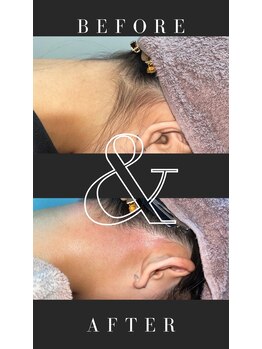 エトワール(etoile)/WAX脱毛♪