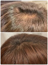 エイチエイチオー 大阪上本町(HHO)/1か月間水素酸素吸入しました！